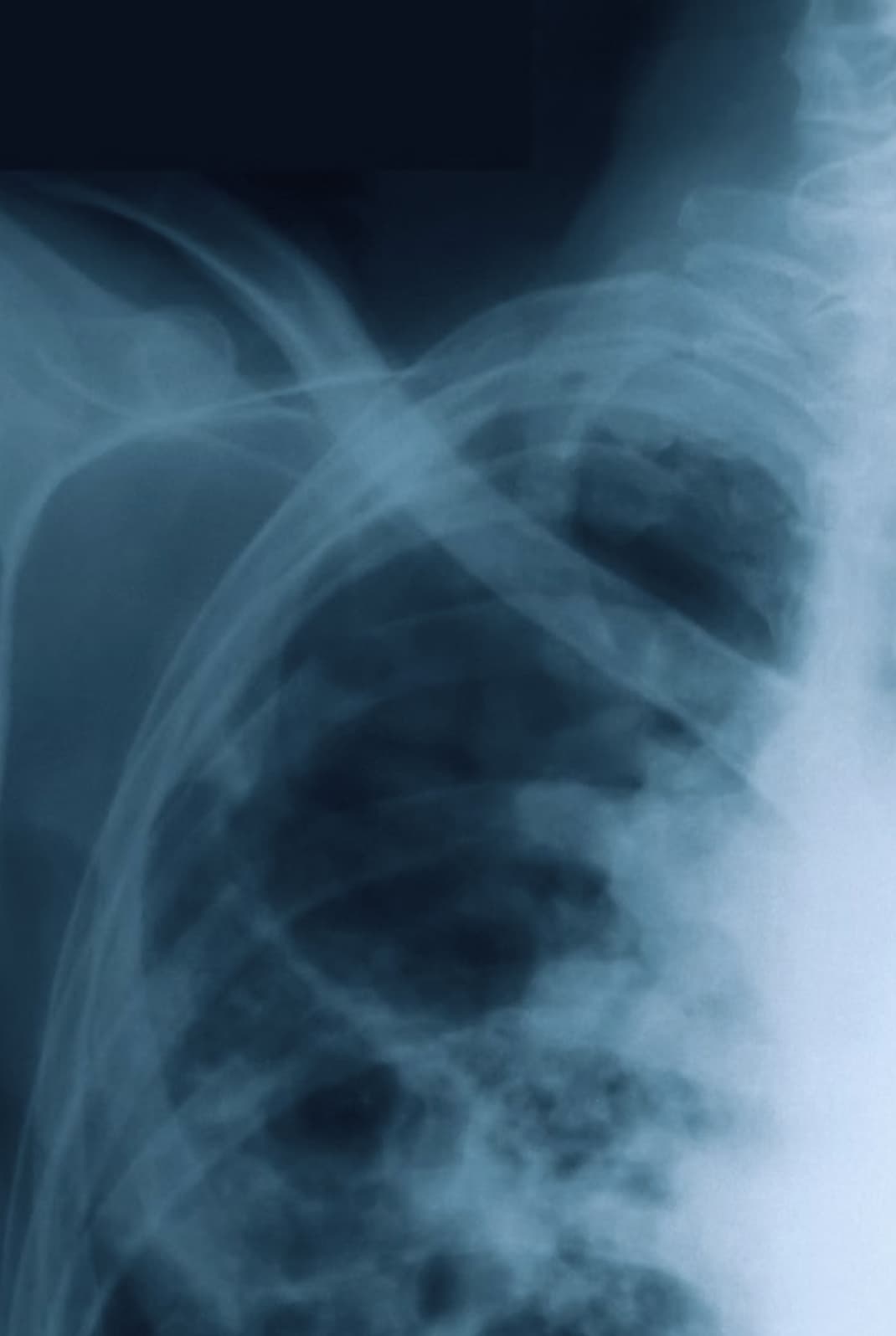 X-ray of a chest